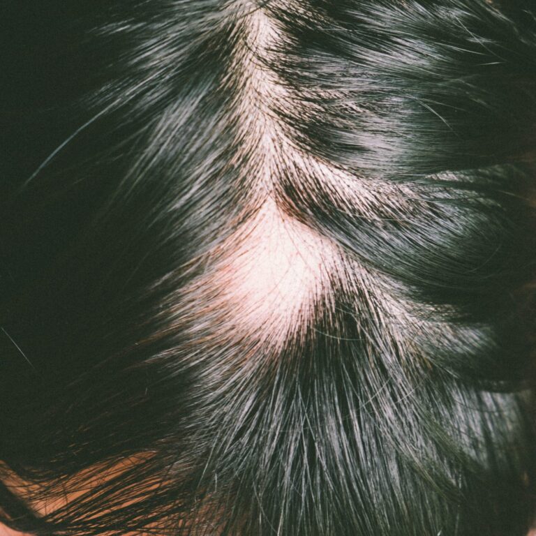 alopesi areata
