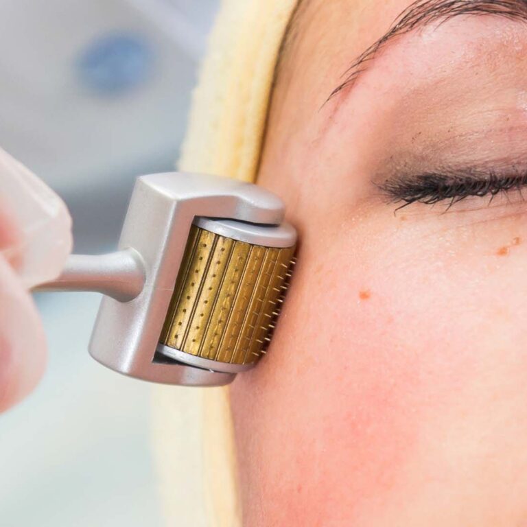 dermapen dermaroller